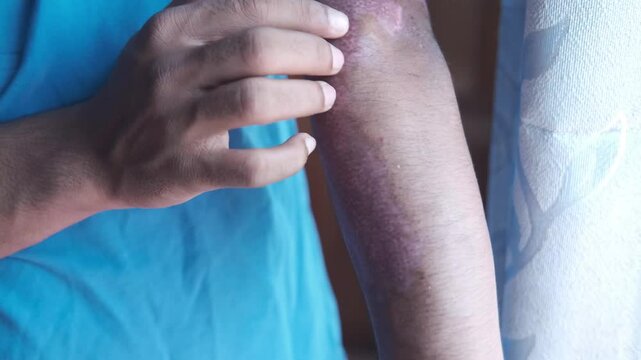 A close-up shot of a person's arm, showcasing a skin condition with reddish and purplish discoloration, with visible texture and scarring