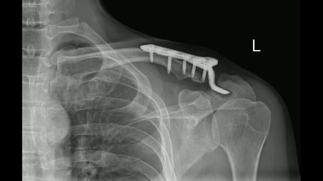 Animated X ray image of left clavicle fracture with internal fixation plate and screws
