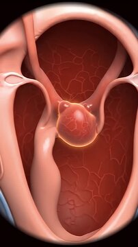 Medical Animation Depicting Acute Laryngitis Inflammation and Swelling of the Larynx with Redness and Vascularity Scientific Illustration and Health Awareness