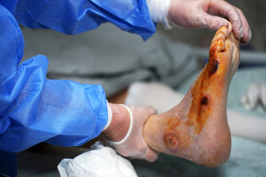 Specialized Medical Care for Chronic Diabetic Foot Ulcer. Clinical specialist treating a severe diabetic foot ulcer. Professional wound debridement and inspection of neuropathic lesions on sole foot