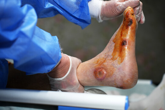 Specialized Medical Care for Chronic Diabetic Foot Ulcer. Clinical specialist treating a severe diabetic foot ulcer. Professional wound debridement and inspection of neuropathic lesions on sole foot