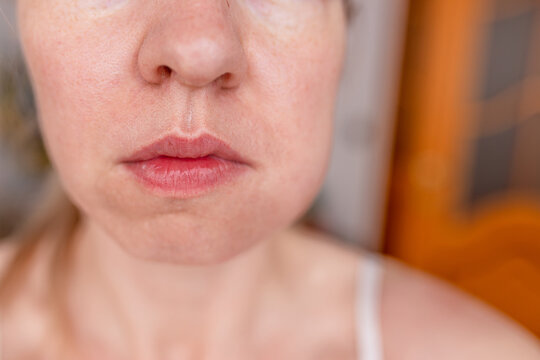 Woman with a swollen cheek and jaw, indicating pain or dental problem