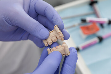 Closeup of dentist holding dental implant jaw model © st.kolesnikov