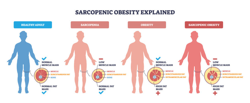 Sarcopenic obesity explained visually, four silhouettes compare muscle loss and fat gain, main objects are body silhouettes, fat-muscle cross-sections, and labels. Outline diagram