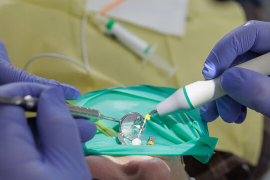 Dentist performing root canal therapy using rotary endodontic file