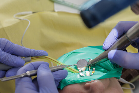Dentist performing root canal therapy with drill and rubber dam