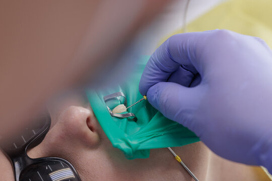 Closeup of endodontic file during root canal therapy