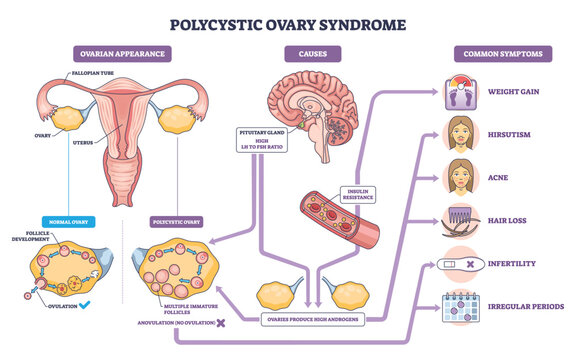 Polycystic ovary syndrome brief diagram maps causes, symptoms, and ovarian changes behind cycle issues, key objects, uterus, ovaries, symptom icons. Outline diagram