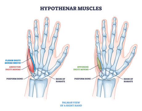 Hypothenar muscles outline shows palm anatomy and little finger control, highlighting abductor digiti minimi, flexor digiti minimi brevis, and opponens digiti minimi. Outline diagram