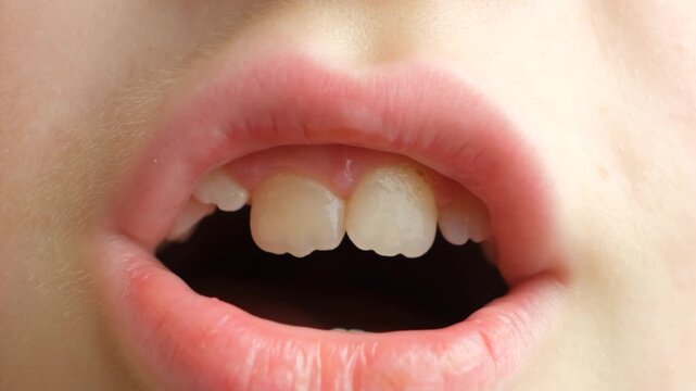Child with crowded teeth. Crooked permanent and baby teeth in a 8 year old child mouth.