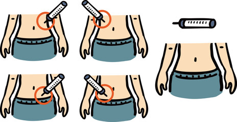 お腹への注射　注射位置　イラストセット