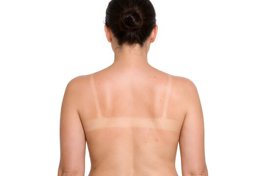 Woman showing tan lines on back from bikini straps after sun tanning, beauty and skin care concept