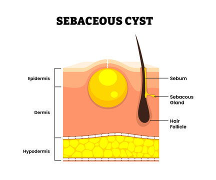 Sebaceous cyst trichilemmal cyst structure. Lump form skin hair follicle. Sebum, epidermis, dermis, hypodermis. Skin layers structure. Dermatology concept science illustration vector.