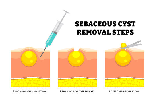 Sebaceous cyst removal steps process. Local anesthesia injection, small incision over the cyst, cyst capsule extraction. Minimally invasive excision. trichilemmal cyst excision. Skin structure.
