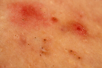 Fototapeta premium Acne close up skin problem with pimple and pores texture detail. Close up pimple in acne shows sebum, comedone, and whitehead. Acne close up with rash, papules, and blemish on skin.