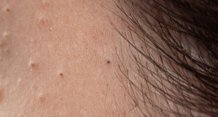 Naklejka premium Acne on skin with papules and follicles. Pimple with whiteheads and irritated pores. Dermatology skincare for acne and epidermis. Detail of pimple with sebum and blemish.