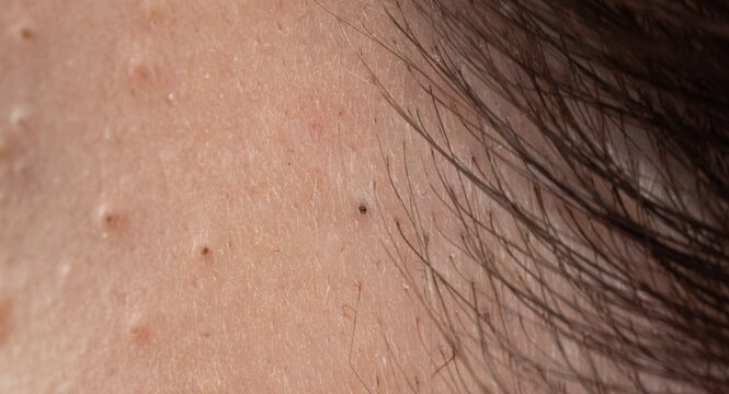 Acne on skin with papules and follicles. Pimple with whiteheads and irritated pores. Dermatology skincare for acne and epidermis. Detail of pimple with sebum and blemish.