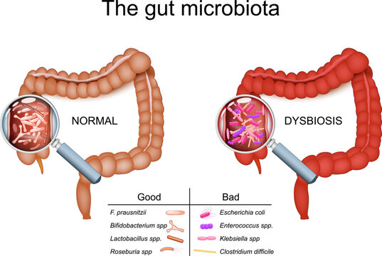 The gut microbiota. Colon with good bacteria and dysbiosis of human large intestine. intestinal flora. 