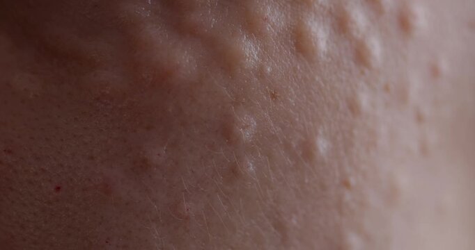 Facial biorevitalization procedure using a hyaluronic acid-based product. Papules on female face after biorevitalization. close-up