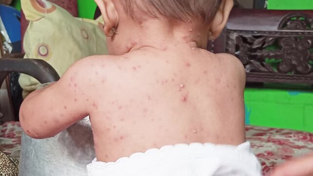 Molluscum contagiosum. This contagious skin condition can appear all over the body, causing rashes and bumps, and often affects children. To prevent infection, medical treatment is still necessary.