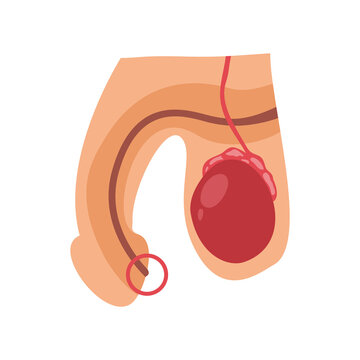 Medical illustration depicts a diagram of male genital anatomy highlighting potential pathology in the groin and scrotal regions.