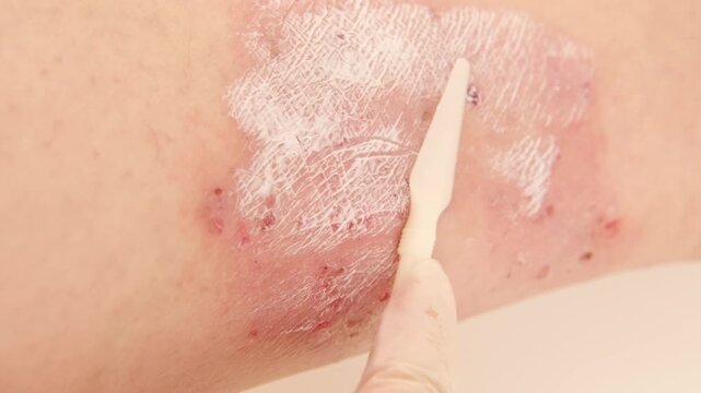 healing wound from on lower leg with scars adult female patient, redness, sores on limb, scarring of skin, concept of medical care, health care, human tissue regeneration, scald on women feet