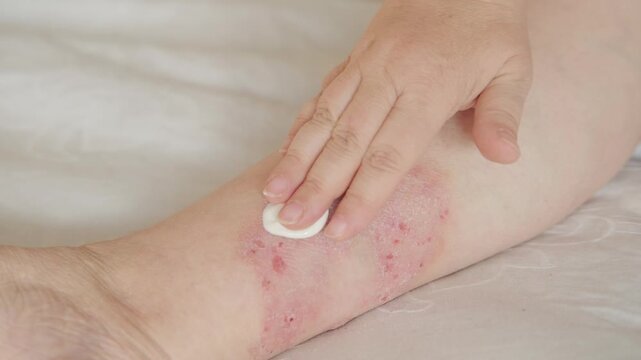 healing wound from on lower leg with scars adult female patient, redness, sores on limb, scarring of skin, concept of medical care, health care, human tissue regeneration, scald on women feet