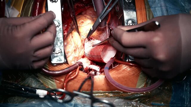 Surgical team performing open-heart procedure with advanced instruments in modern operating theater. Concept of medical technologies and surgery.
