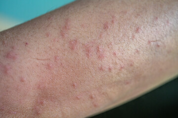 Fototapeta premium Close up of rashes occur on woman arm. A rash on your arms can occur due to an allergic reaction, contact with irritants, infection, or an underlying medical condition like psoriasis.