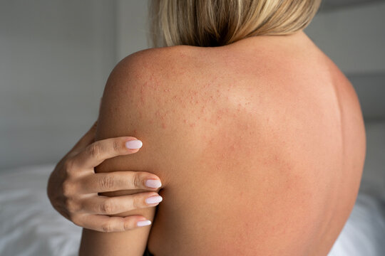 Close-up of female shoulder and back with allergic rash after sun exposure. Red irritated skin with small bumps, young woman touching shoulder, concept of sun allergy, dermatology problem