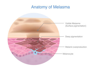 Skin anatomy of Melasma, where excess melanin forms beneath. Dark spots on the surface, causing uneven skin color. Beauty medical diagram.