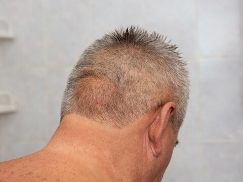 A close-up of a man's back of the head and neck, showing a visible subcutaneous lipoma on the scalp