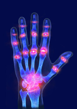 Gicht (Urikopathie) an der Hand, R&ouml;ntgenbild