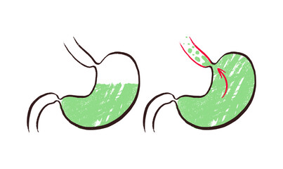 Fototapeta premium Gastroesophageal reflux pain