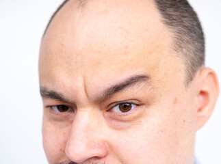 Obraz premium Closeup portrait man with brown eyes and shaved head, white background, male baldness and growing need professional hair restoration, natural skin texture, intensity glance, human forehead