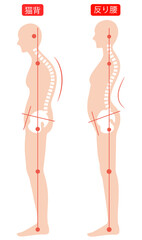 猫背と反り腰　背骨と骨盤
