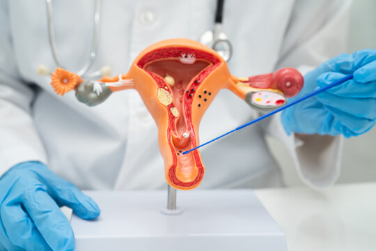 Doctor holding human uterus model for vaginal and cervix pap smear check up in the obstetrics and gynecology.
