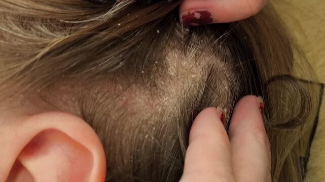 Seborrheic dermatitis on the scalp. Scalp scalpel. Dandruff on a woman's hair