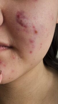 The girl touches the pimples on her face with her finger, hand. Acne on the face of a young girl. Problem skin in adolescents