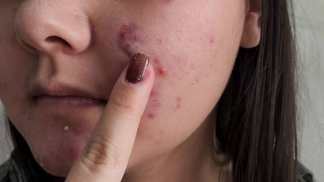 The girl touches the pimples on her face with her finger, hand. Acne on the face of a young girl. Problem skin in adolescents