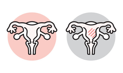 シンプル　イラスト　子宮の健康状態の比較イメージ 女性の健康 ベクターイラスト