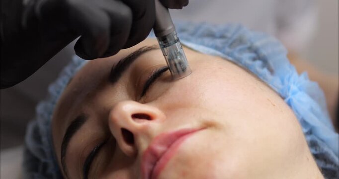 Cosmetic procedure microneedling on the skin of a woman's face. Restoration and regeneration of facial skin. Wrinkle smoothing. Health and beauty.