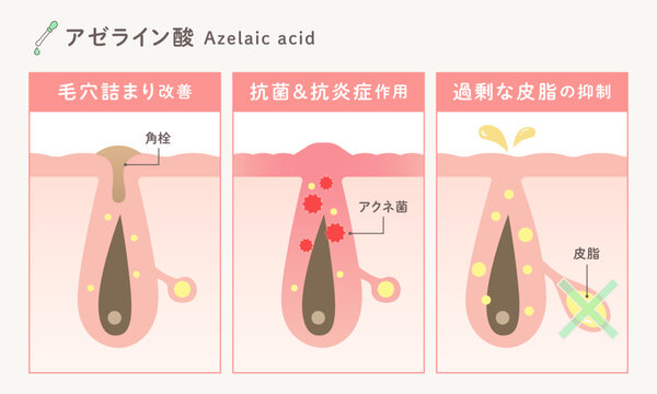 アゼライン酸の美容効果｜毛穴詰まり改善・抗菌抗炎症・皮脂抑制のスキンケア成分図解