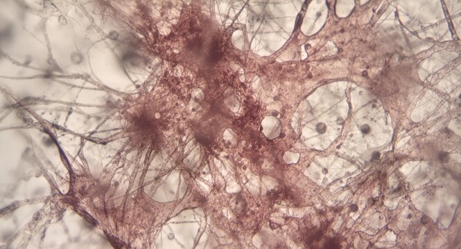 Microscopic view of leiomyosarcoma displaying complex smooth muscle tumor cell structures