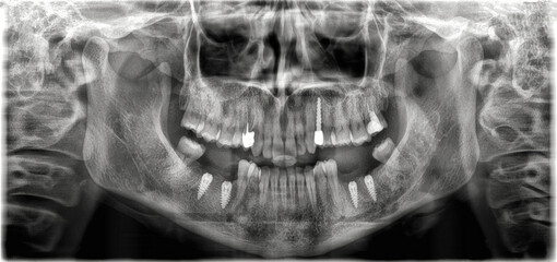 Dental X-ray image showing full jaw structure, teeth alignment, and multiple dental implants used for diagnosis and oral healthcare evaluation. © Lilith_Saly