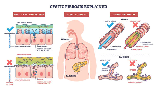 Cystic fibrosis explained, visual summary of CFTR mutation causing thick mucus in lungs and pancreas, contrasting clear and blocked airways to show disease effects, transparent background.