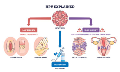 HPV explained overview illustrates virus types, vaccine syringe, and cervix, showing how low-risk cause warts and high-risk lead to cancer, with prevention guidance, transparent background.