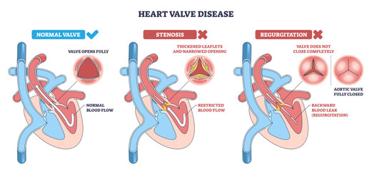Heart valve disease diagram compares normal, stenosis, and regurgitation, shows heart, aortic valve, and blood flow arrows to explain function and defects, transparent background.