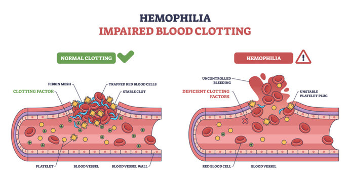 Hemophilia impaired clotting concept compares normal vs deficient repair in a blood vessel, highlighting platelets, red blood cells, and missing clotting factors causing bleeding.