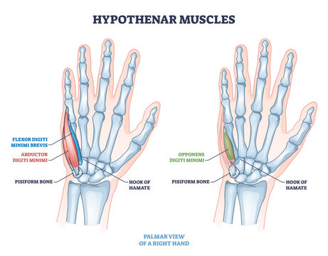 Hypothenar muscles outline shows palm anatomy and little finger control, highlighting abductor digiti minimi, flexor digiti minimi brevis, and opponens digiti minimi, transparent background.